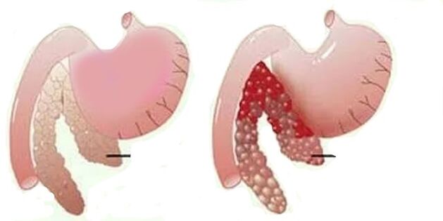 Pancreatite